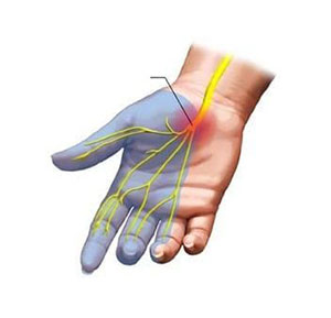 Featured image for “Carpal Tunnel Syndrome”