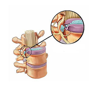 Featured image for “Herniated Disc”